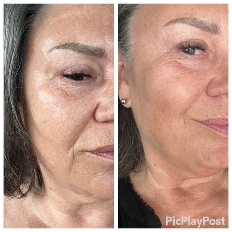 Skinora Radiance Face før og etter – fastere og mer definert kjevelinje, mindre synlig slapphet langs kjeven etter 8 ukers bruk. Testpanel, resultater varierer