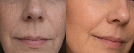 Før og etter-bilde av kunde som viser glattere hud og mindre porer etter bruk av Skinora Radiance LED-maske