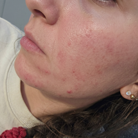 Før behandling med Skinora Clear