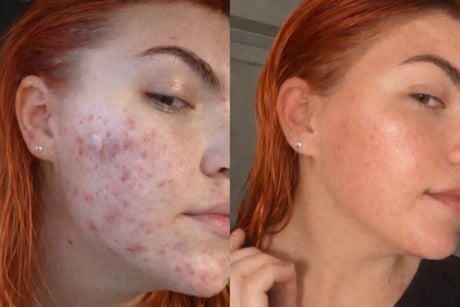 Skinora Clear før og etter – uretusjert mobilbilde som viser mindre synlige utbrudd og et jevnere hudinntrykk etter jevn bruk over flere uker. Resultater varierer.