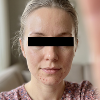 Før behandling med Skinora Clear