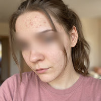 Før behandling med Skinora Clear