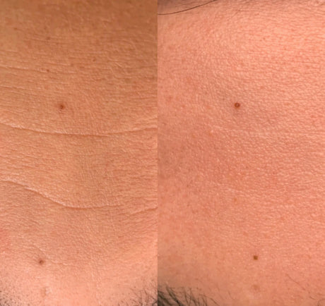 Før og etter-bilde av kunde som viser glattere hud, mindre rynker og mindre porer etter bruk av Skinora Radiance LED-maske