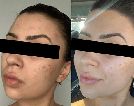 Skinora Clear før og etter – kundeopplevelse med klarere hudlook, jevnere tekstur og glattere overflate, slik huden kan se ut etter regelmessig bruk over tid.