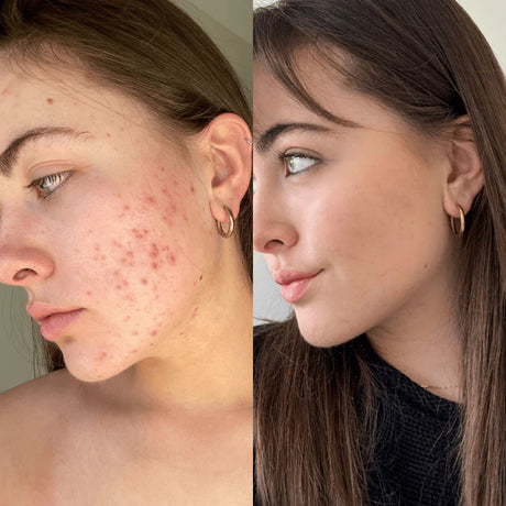 Skinora Clear før og etter – kunde som viser mindre fremtredende utbrudd og et jevnere helhetsinntrykk, for en klarere og mer “clean” hudlook med konsistent rutine.