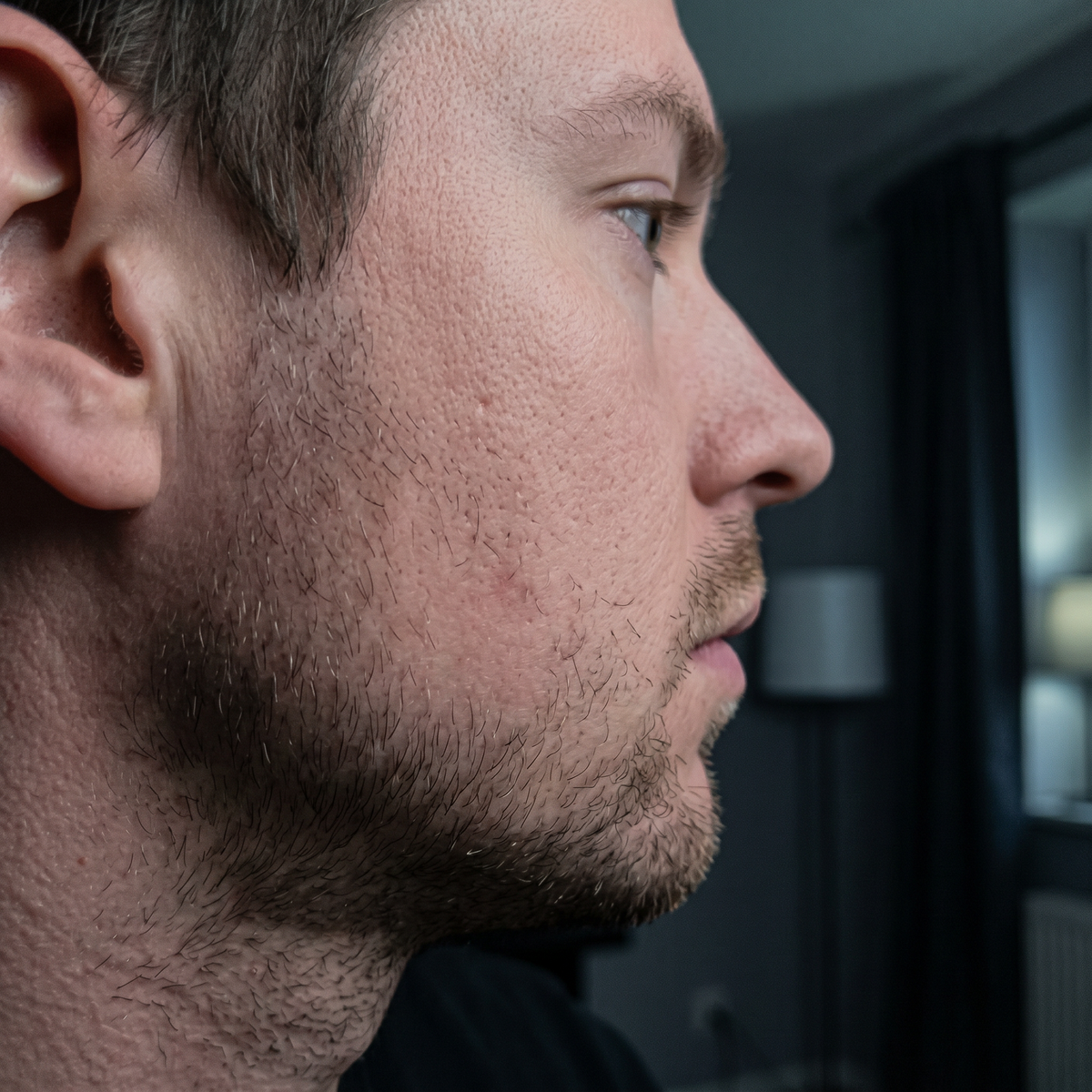 Sondre, 29 – voksenakne og rødhet etter 6 uker med Skinora Clear