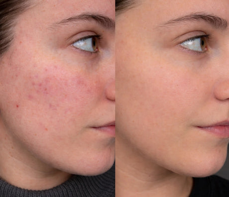 Før og etter-bilde av kunde som viser glattere hud og renere hud etter bruk av Skinora Clear LED-maske