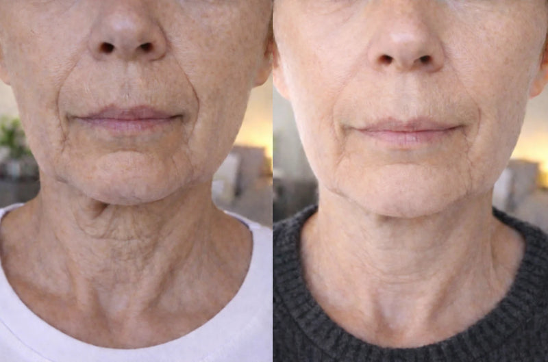 Før og etter: hals og kjevelinje ser glattere og mer jevn ut etter regelmessig bruk.