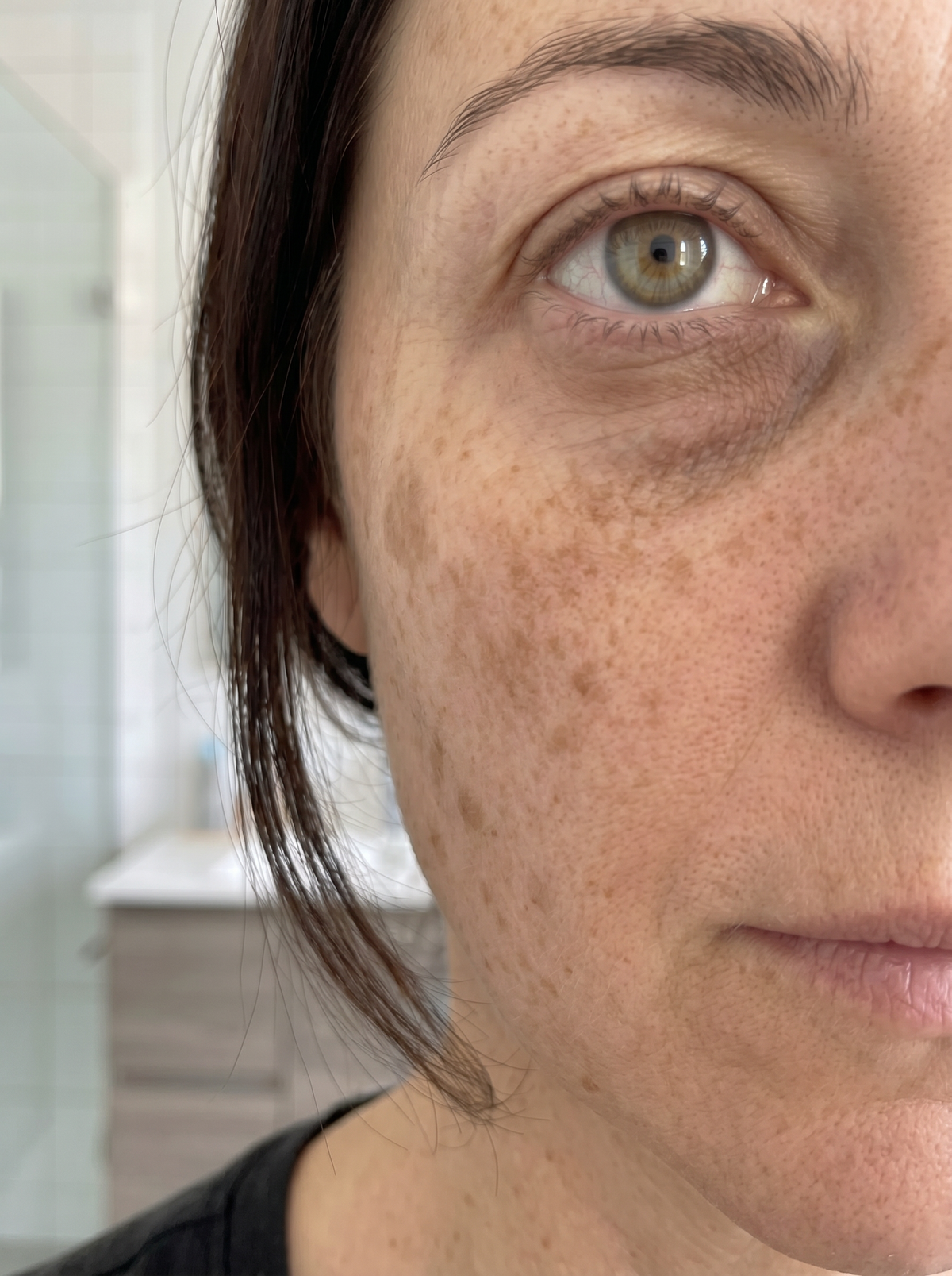 Ingrid, 44 – før behandling med Skinora Radiance Face