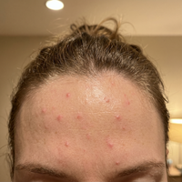 Før behandling med Skinora Clear