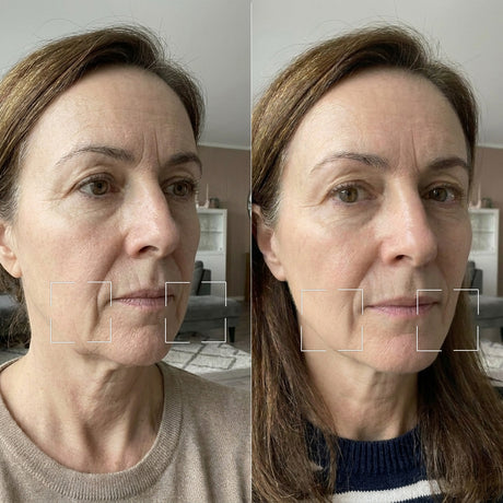 Skinora Radiance Face før og etter – fastere og mer definert kjevelinje, mindre synlig slapphet langs kjeven etter 8 ukers bruk. Testpanel, resultater varierer
