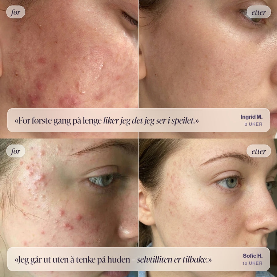 For og etter bilder: kunder viser renere hud etter bruk av Skinora Clear mot akne og urenheter LED light therapy device