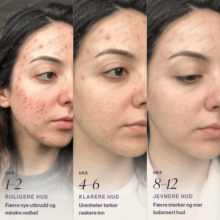 Hudforbedring med Skinora Clear over tid: roligere hud etter 1-2 uker, klarere hud etter 4-6 uker, jevnere hud etter 8-12 uker LED light therapy device