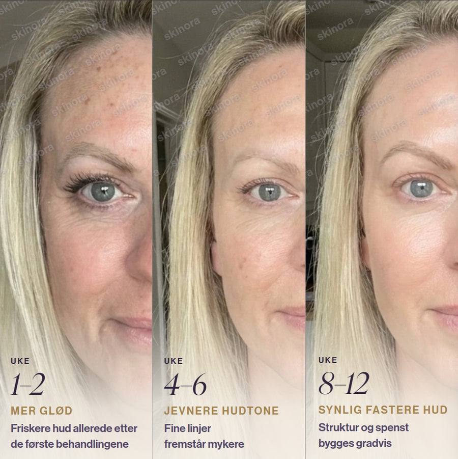 Tre bilder som viser huduttrykk etter 1-2, 4-6 og 8-12 uker med Skinora Radiance Face: mer glød, jevnere hudtone og synlig fastere hud LED light therapy device