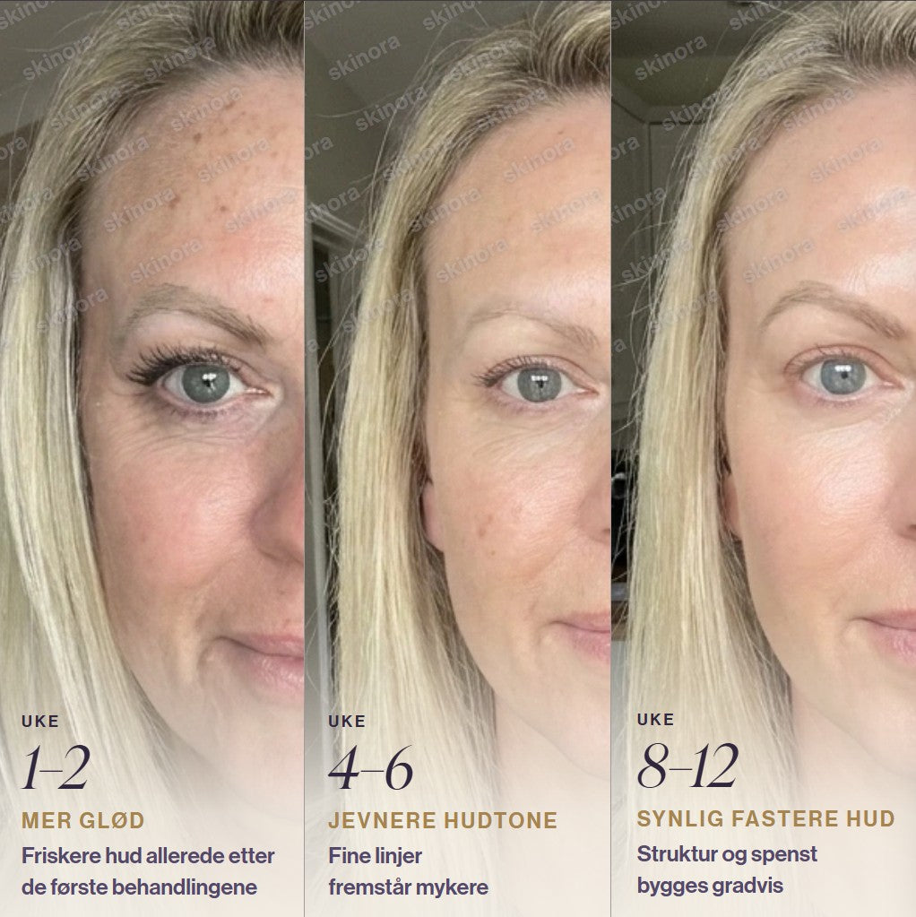 Tre bilder som viser huduttrykk etter 1-2, 4-6 og 8-12 uker med Skinora Radiance Face: mer glød, jevnere hudtone og synlig fastere hud