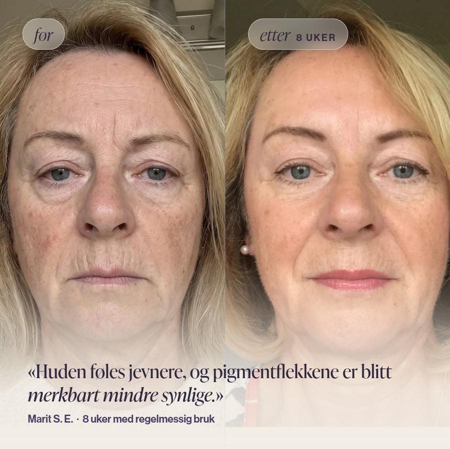 Før og etter-bilde av kvinne som viser jevnere hud og synlig reduserte pigmentflekker etter 8 uker med Skinora Radiance Face LED light therapy device