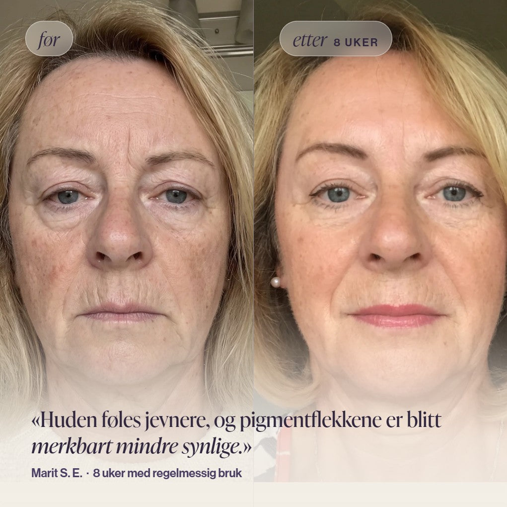 Før og etter-bilde av kvinne som viser jevnere hud og synlig reduserte pigmentflekker etter 8 uker med Skinora Radiance Face